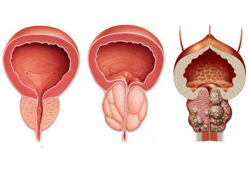 Etapas da prostatite e necesidade de tratamento con Prostavit