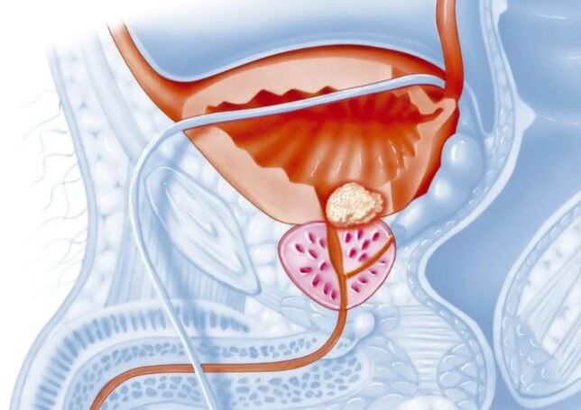 Características da forma crónica de prostatite