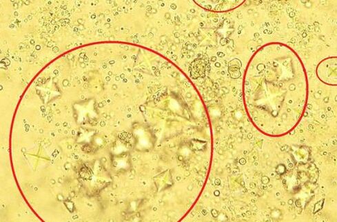 Así son os cristais de sal contidos na orina ao microscopio na prostatite calculada